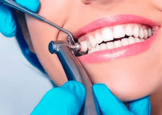 Resultado de diseño de sonrisa con carillas estéticas en Odontología Integral